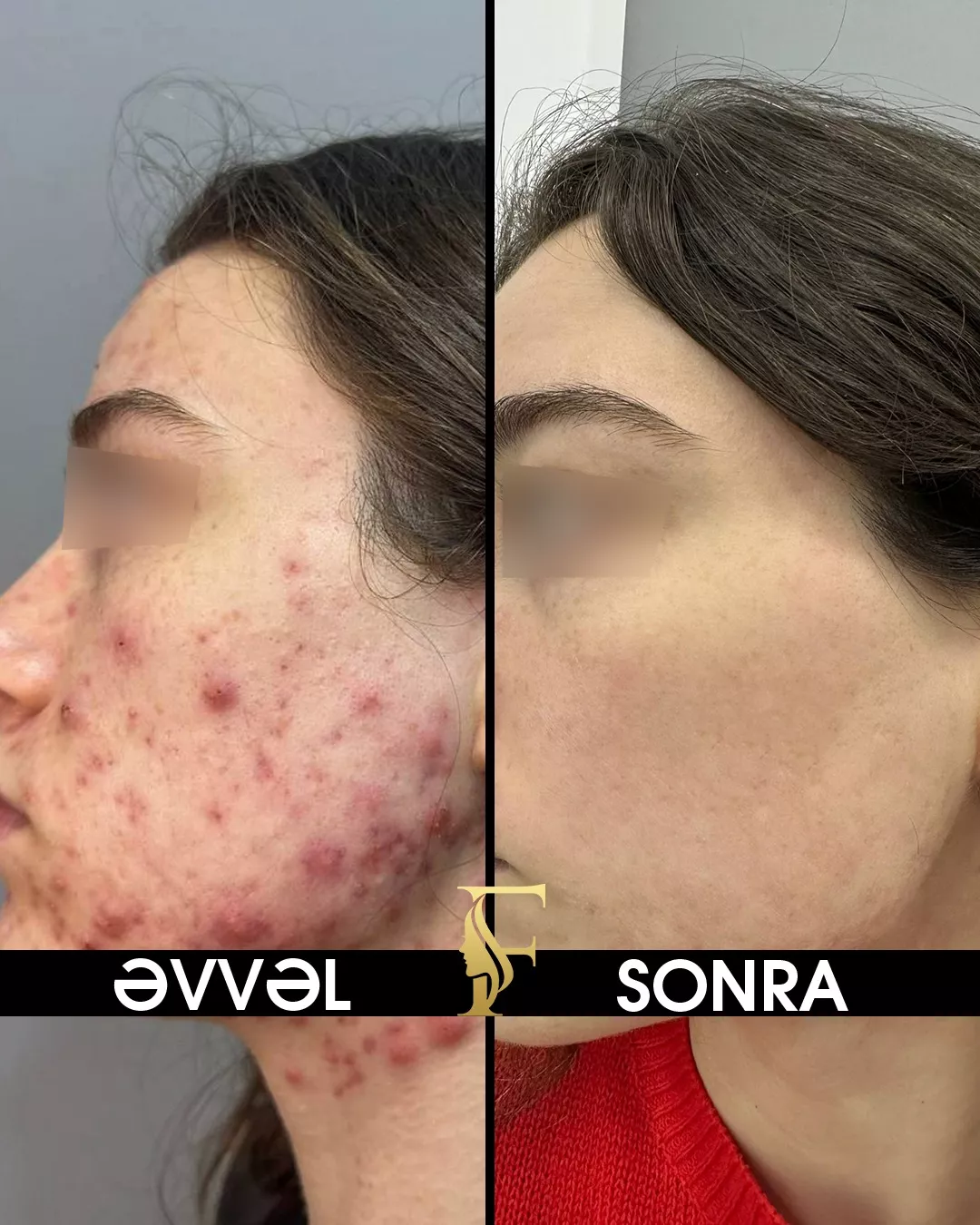 Sızanaq Müalicəsi